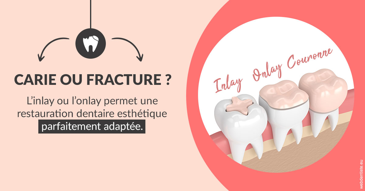 https://dr-pissis-patrick.chirurgiens-dentistes.fr/T2 2023 - Carie ou fracture 2