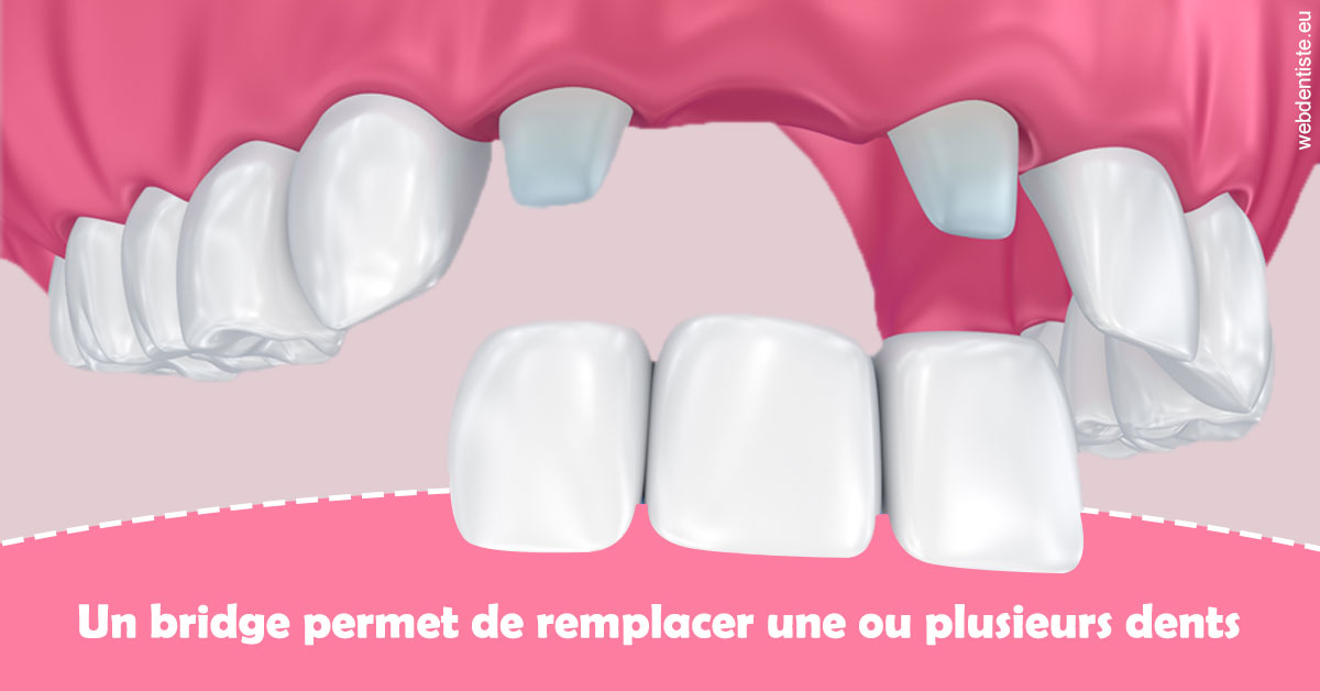 https://dr-pissis-patrick.chirurgiens-dentistes.fr/Bridge remplacer dents 2