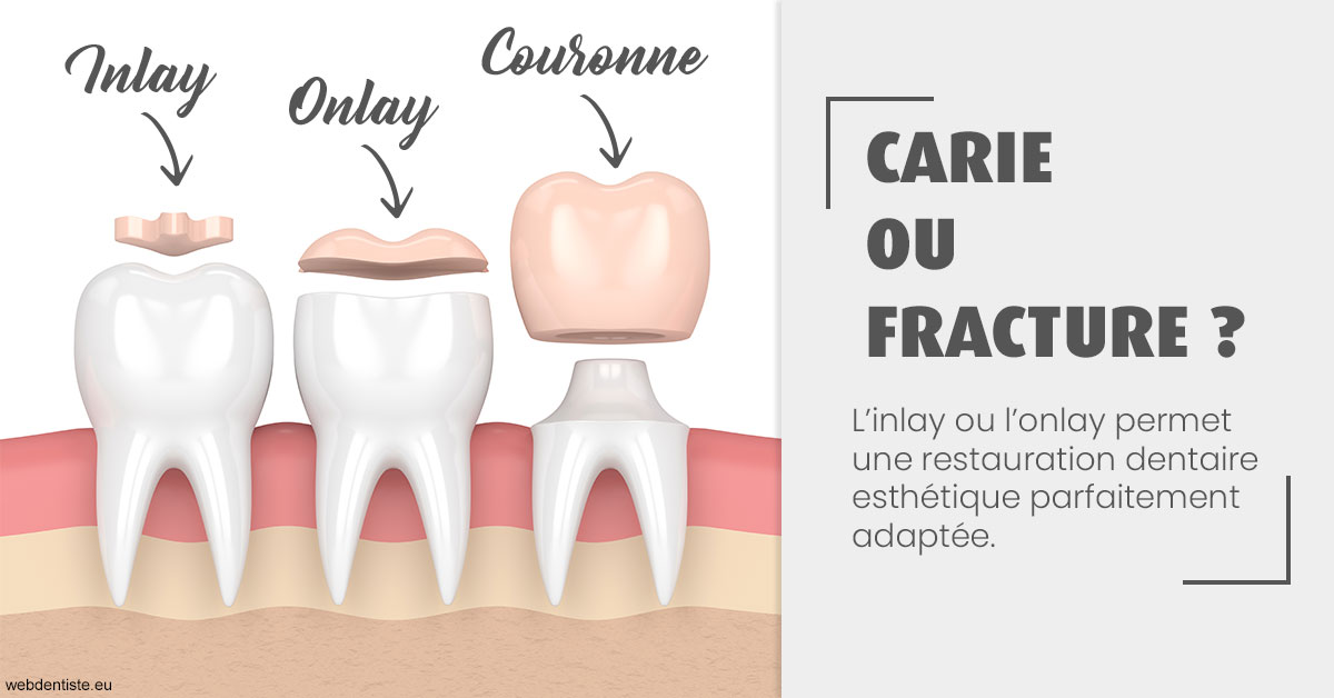 https://dr-pissis-patrick.chirurgiens-dentistes.fr/T2 2023 - Carie ou fracture 1