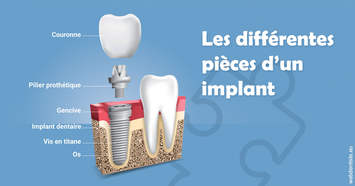https://dr-pissis-patrick.chirurgiens-dentistes.fr/Les différentes pièces d’un implant 1